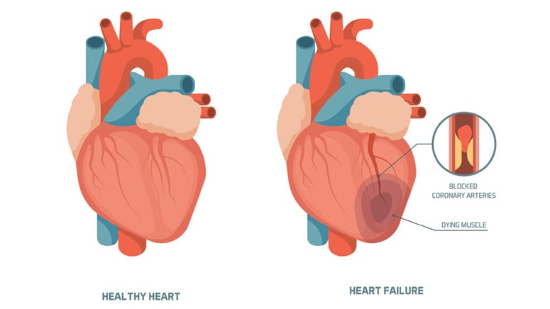 what-are-the-four-stages-of-congestive-heart-failure-entirely-health