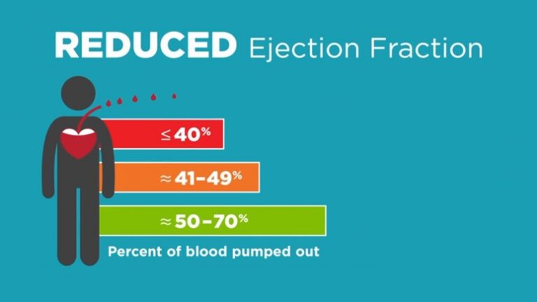 What Are the Four Stages of Congestive Heart Failure? – Page 3