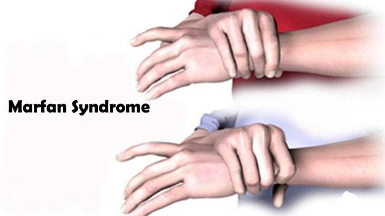 Marfan syndrome что это