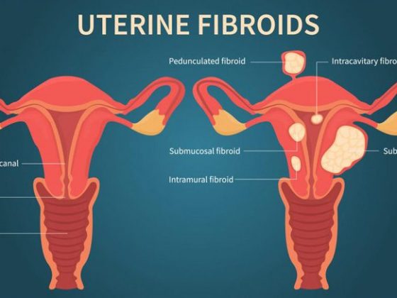 Fibroids Vs. Ovarian Cysts: How Do They Differ? – Entirely Health