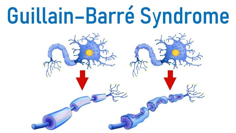 Guillain-Bare Syndrome Fact Sheet – Page 2 – Entirely Health