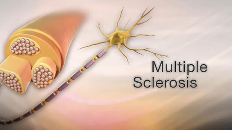 Early Signs And Symptoms of Multiple Sclerosis – Entirely Health