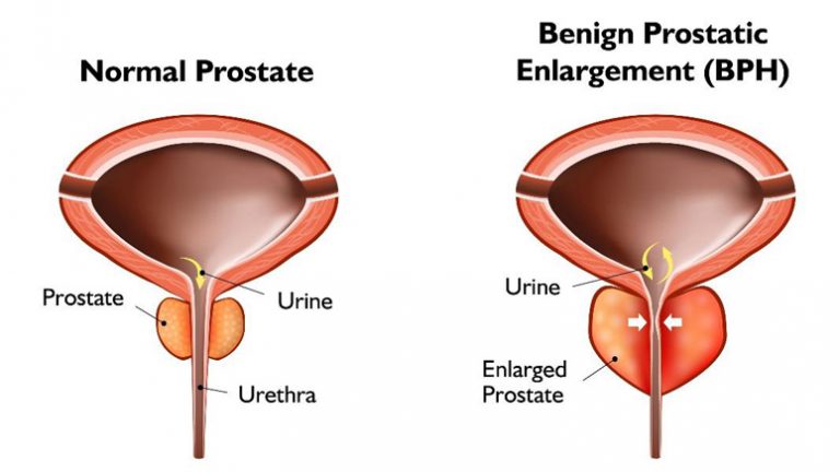 Benign Prostatic Hyperplasia Bph Symptoms And Causes Entirely Health