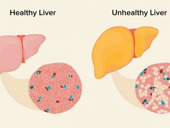 8 Common Causes Of Fatty Liver Disease Entirely Health