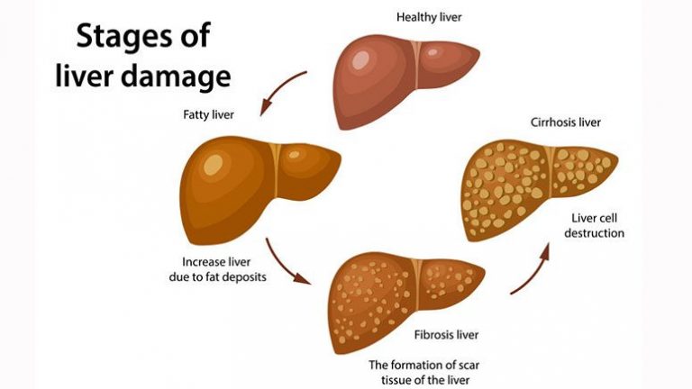 Elevated Liver Enzymes: What It is, Causes, Prevention, and Treatment ...