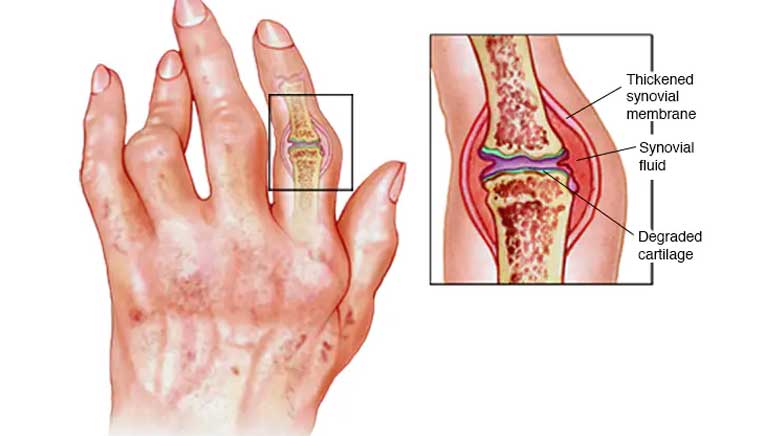 Rheumatoid Arthritis Flare Ups Symptoms Tips And More Page 7 Entirely Health 7367