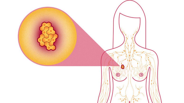 Metastatic Breast Cancer In Bones What To Know Entirely Health 7648