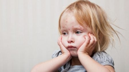 Can You Get Shingles If You Haven’t Had Chickenpox? – Entirely Health