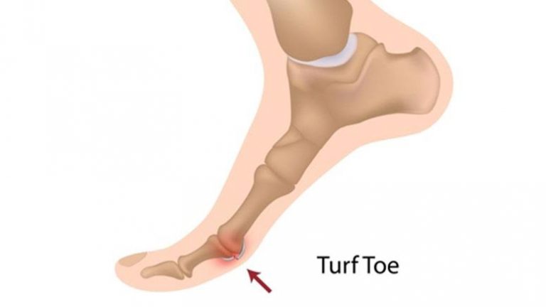 Turf Toe vs Gout: Similarities and Differences – Page 6 – Entirely Health