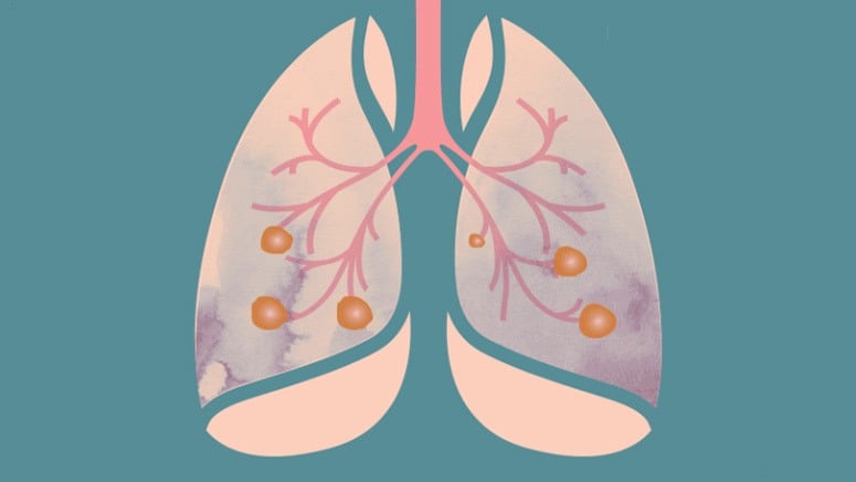 An Overview of EGFR Mutation Lung Cancer – Entirely Health