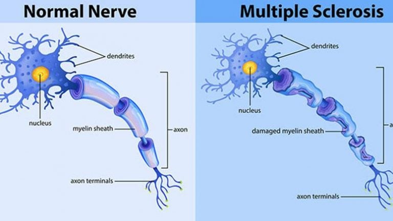 Temperature Sensitivity in Multiple Sclerosis – Causes, Symptoms, and ...