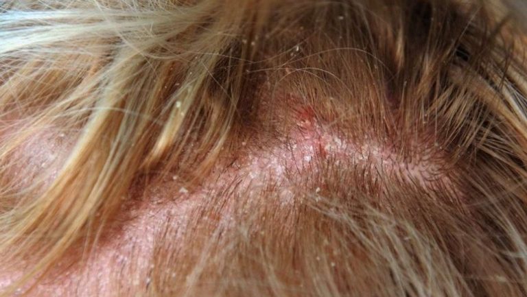 Seborrheic Dermatitis Symptoms Causes Diagnosis And Treatment Entirely Health