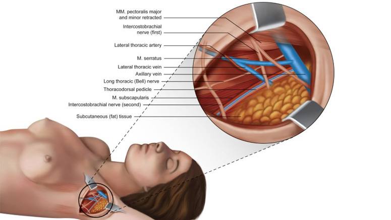 Axillary Lymph Node Dissection Page 6 Entirely Health 