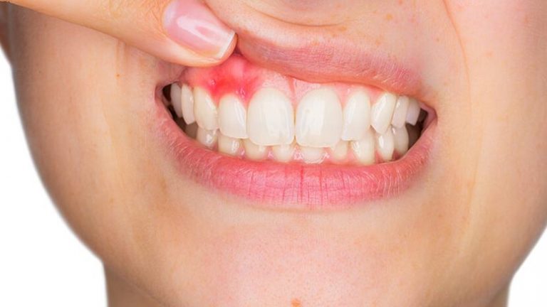 How to Identify and Treat a Cut on the Gums – Entirely Health