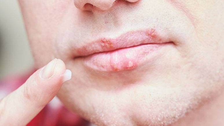 Angular Cheilitis: Symptoms, Causes & Treatments – Page 8 – Entirely Health