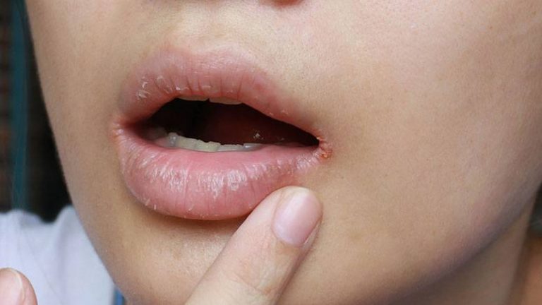 Angular Cheilitis: Symptoms, Causes & Treatments – Page 7 – Entirely Health