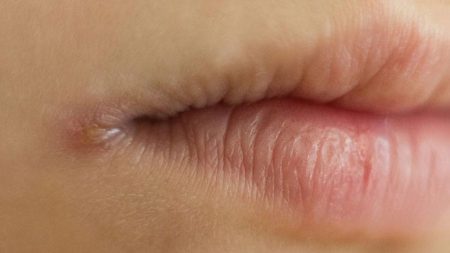 Angular Cheilitis: Symptoms, Causes & Treatments – Entirely Health