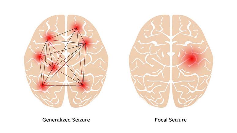 What Does it Feel Like to Have a Seizure? Page 5 Entirely Health