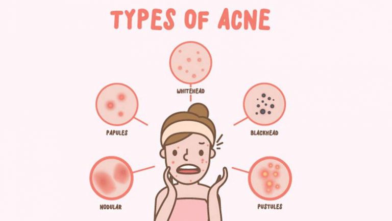 Pitted Acne Scars – Causes and Treatment Options – Entirely Health