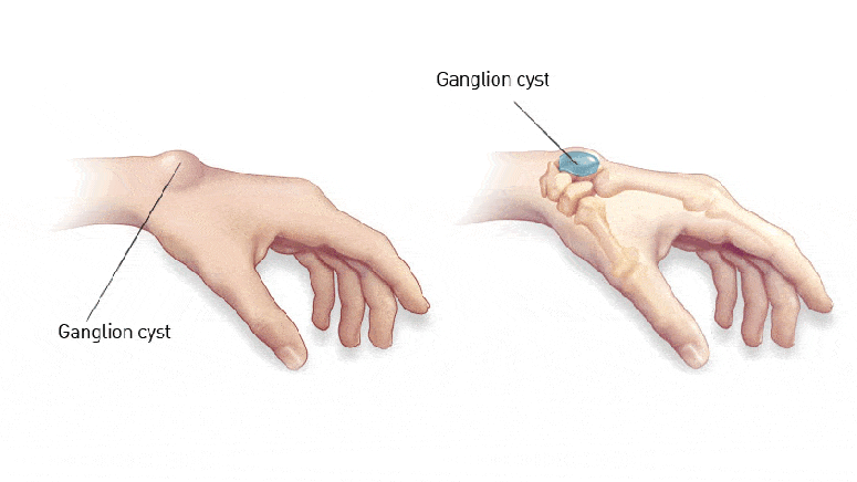 Ganglion Cysts Symptoms Causes Diagnosis And Treatment Page 5 Entirely Health