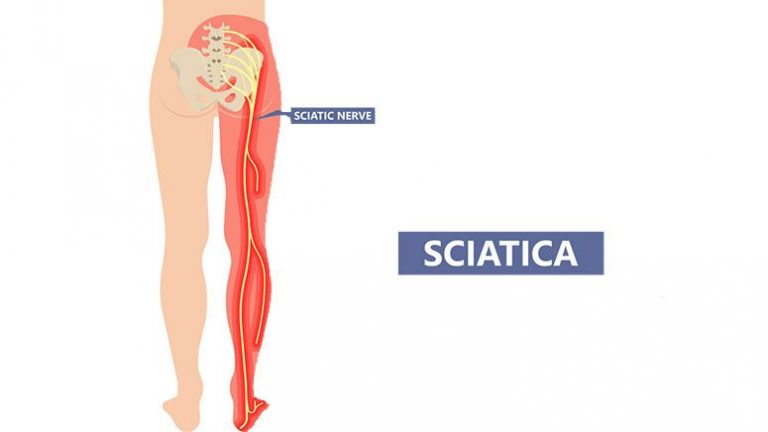 Why Does My Sciatica Keep Coming Back