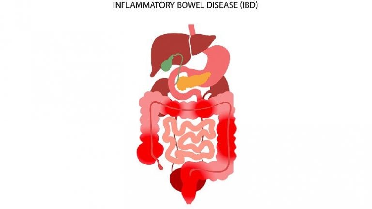 how-does-alcohol-affect-crohn-s-disease-entirely-health