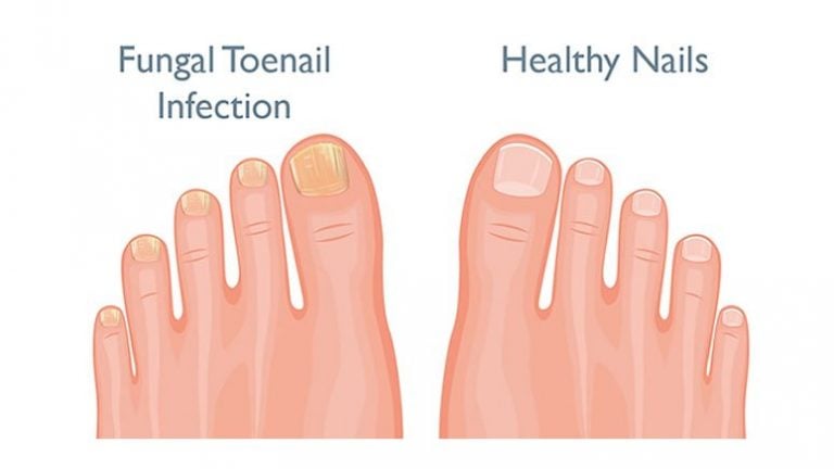 Fingernail and Toenail Pain – Symptoms, Causes and Treatments – Page 3 ...