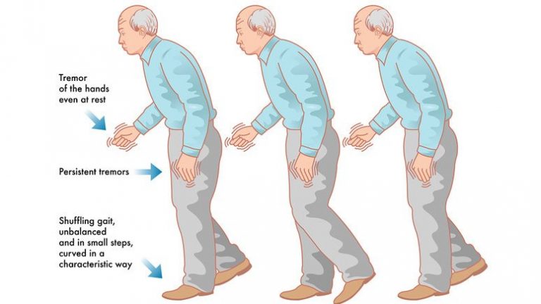 Vascular Parkinsonism – Causes, Symptoms And Treatment – Entirely Health