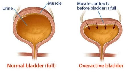 Treatment Options for Overactive Bladder – Entirely Health