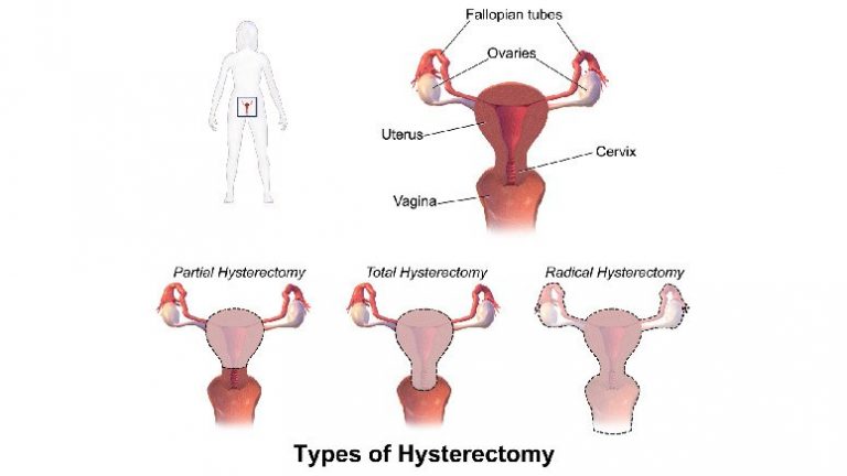 Hysterectomy Purpose Procedure Benefits Risks And Recovery Page