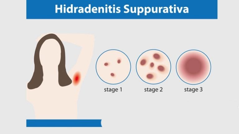 Hidradenitis Suppurativa Symptoms Causes And Treatment Page 6 Entirely Health 2217