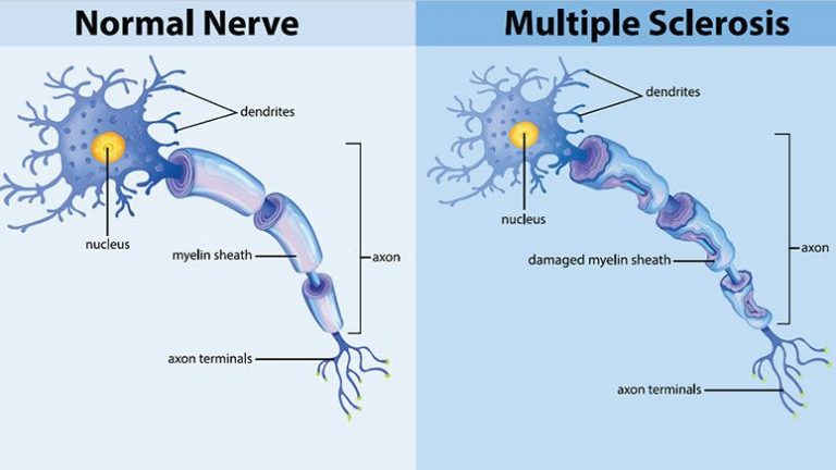 The Ms Hug Symptoms Triggers Treatments And More Entirely Health