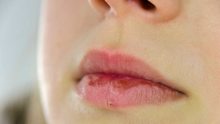 What to Do About a Scab on Your Lips – Entirely Health