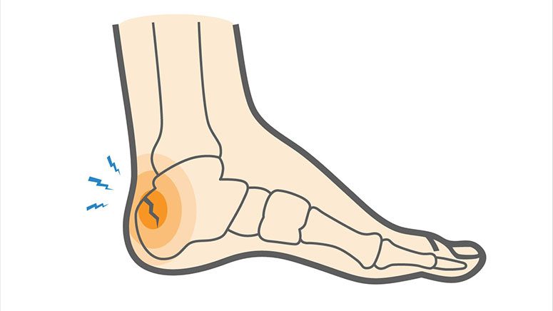 Heel Pain: Causes, Prevention, and Treatments – Page 5 – Entirely Health