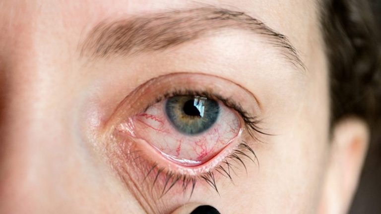 Uveitis: Causes, Types, Diagnosis and Symptoms – Entirely Health