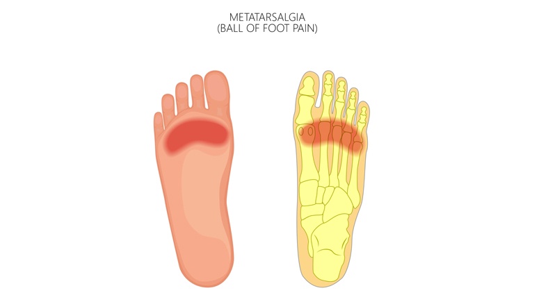 Metatarsalgia (Ball of Foot Pain): Symptoms and Causes – Entirely Health