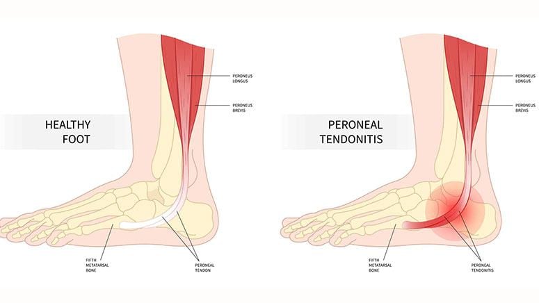 Peroneal Tendonitis: Causes Symptoms, Treatment, Prevention – Page 10 ...