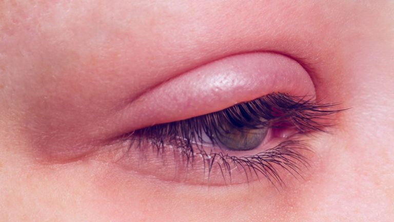 Blepharitis (Eyelid Inflammation): Causes, Diagnosis & Treatment ...