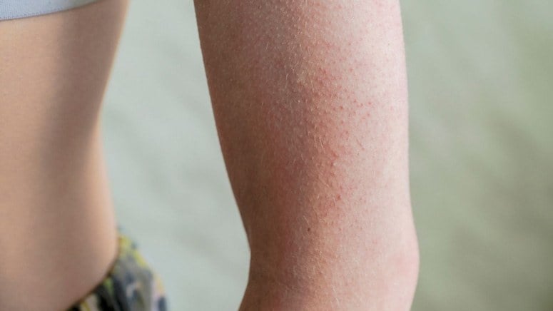 Keratosis Pilaris: What It Is, Causes, Symptoms, And Treatment – Page 4 ...