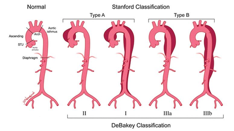 Aortic Dissection: Causes, Symptoms & Treatments – Page 2 – Entirely Health