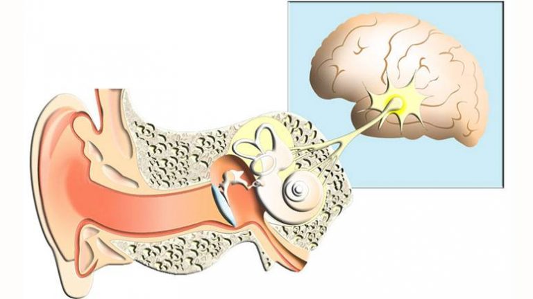 Schwannoma (Neurilemoma): What It Is, Causes, Symptoms & Treatment ...