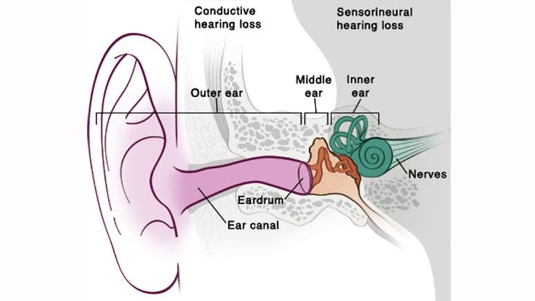 Hearing Loss: Types, Symptoms, Causes & Treatment – Page 3 – Entirely ...