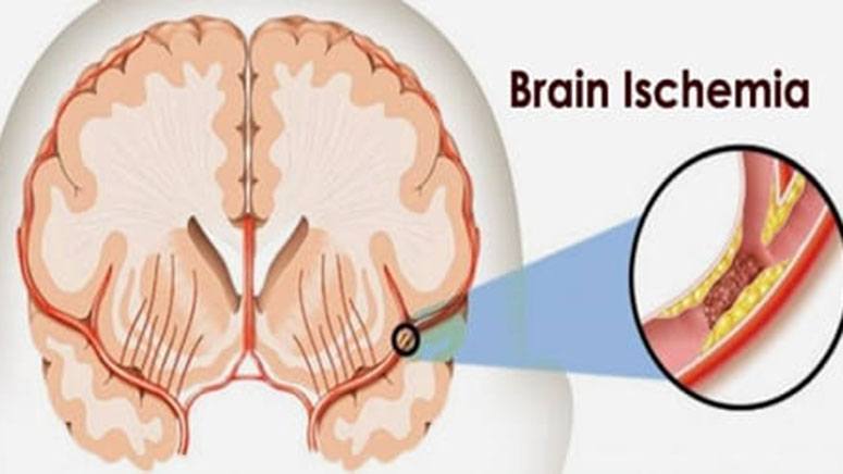 ISCHEMIA SYMPTOMS CAUSES TREATMENTS AND PROGNOSIS visual data 3