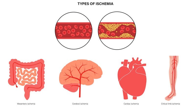 ISCHEMIA SYMPTOMS CAUSES TREATMENTS AND PROGNOSIS visual data 7